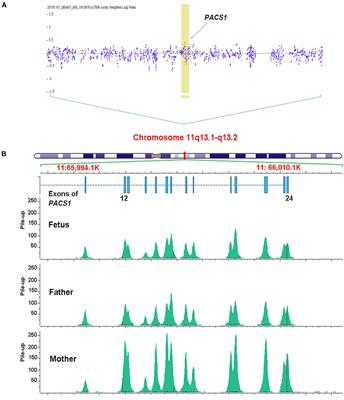 A Novel Multi-Exon Deletion of PACS1 in a Three-Generation Pedigree: Supplements to PACS1 Neurodevelopmental Disorder Spectrum